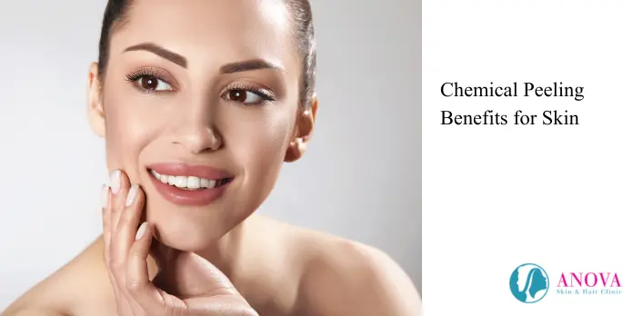 chemical peeling benefits for skin