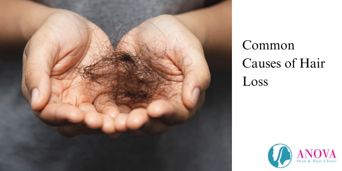 Common Causes of Hair Loss That Determine the Right Treatment
