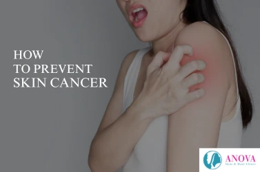 How to Prevent Skin Cancer: Tips for Lifelong Skin Protection