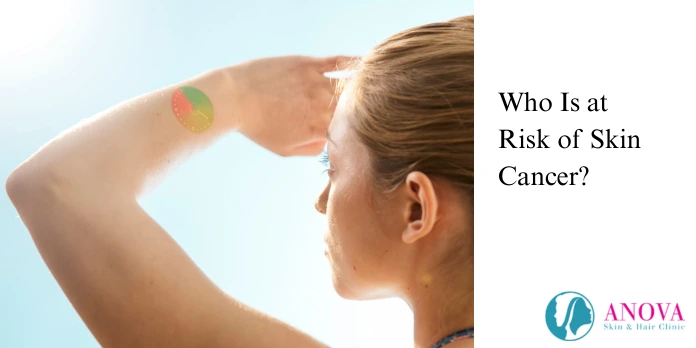 Who Is at Risk of Skin Cancer?
