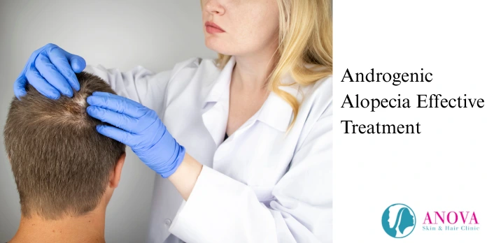 Effective Treatment Options for Androgenic Alopecia