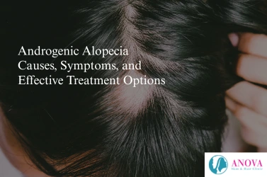 androgenic alopecia