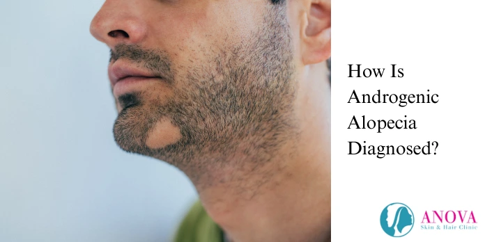 How Is Androgenic Alopecia Diagnosed?