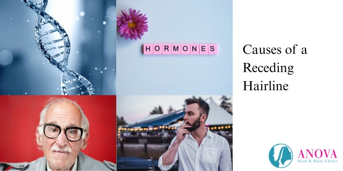 Causes of a Receding Hairline