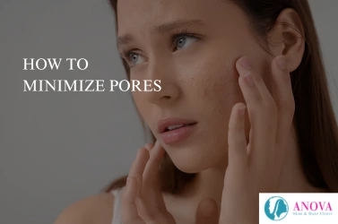 How to Minimize Pores: Causes and Open Pores Treatment