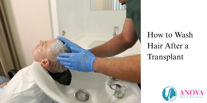 How to Wash Hair After a Transplant (Step-by-Step)