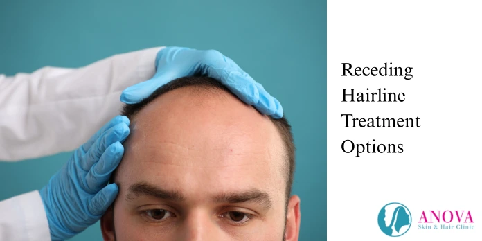 Receding Hairline Treatment Options