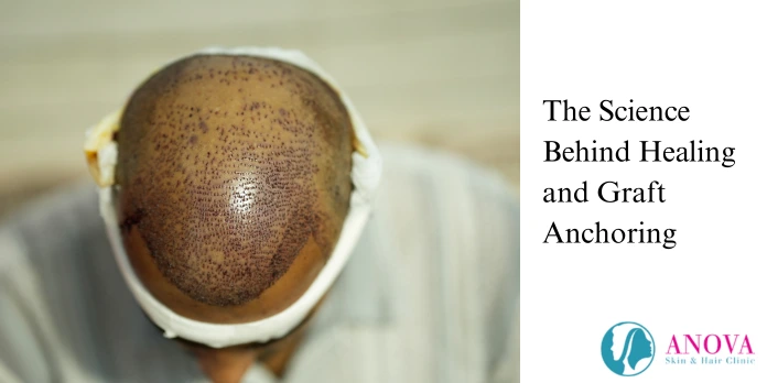 The Science Behind Healing and Graft Anchoring