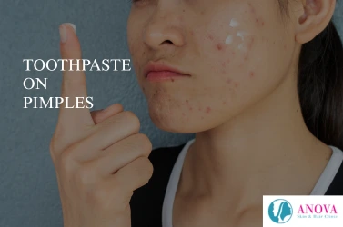 Toothpaste on Pimples