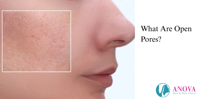 What Are Open Pores?
