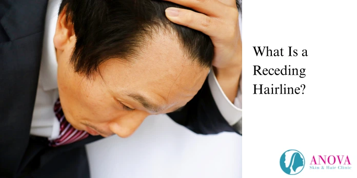 What Is a Receding Hairline?
