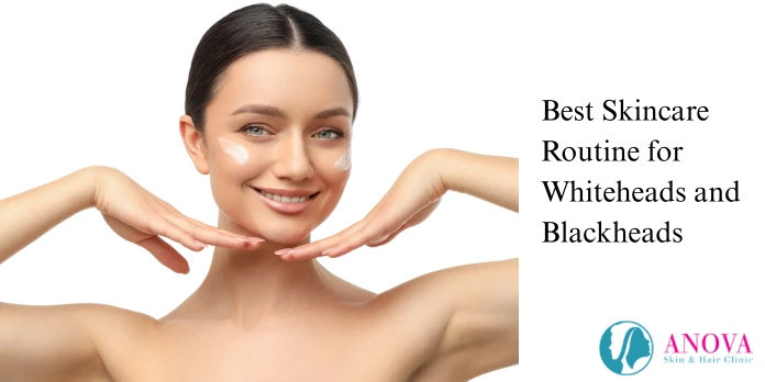 Best Skincare Routine for Whiteheads and Blackheads