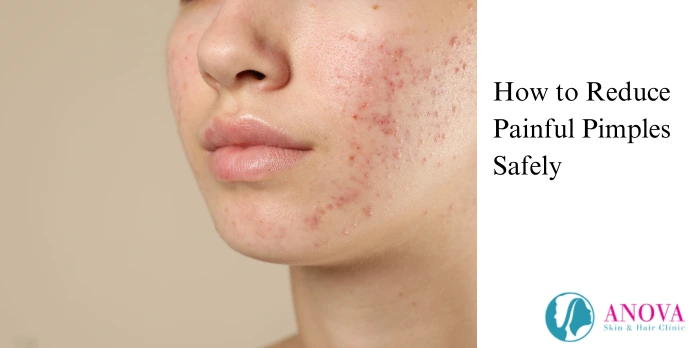 How to Reduce Painful Pimples Safely