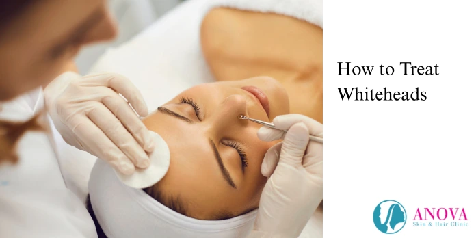 How to Treat Whiteheads