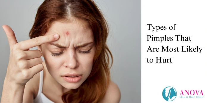 Types of Pimples That Are Most Likely to Hurt