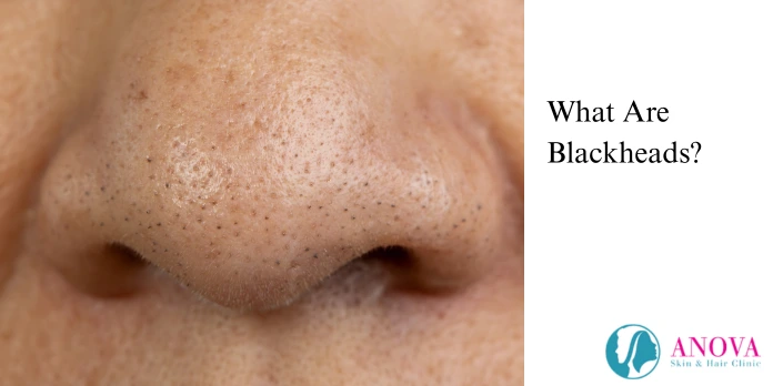 What Are Blackheads?