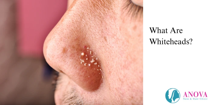 What Are Whiteheads?