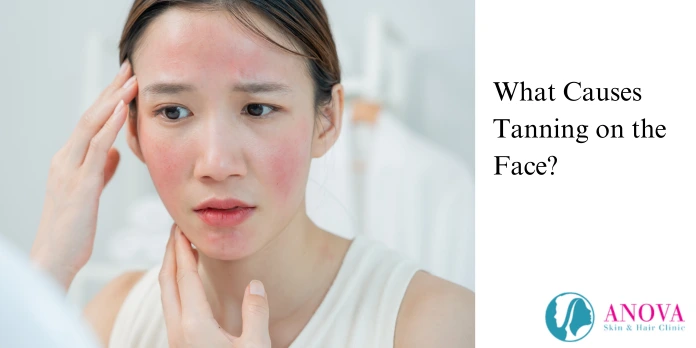 What Causes Tanning on the Face?