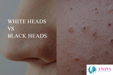 Whiteheads vs Blackheads: Causes, Differences, and Treatments