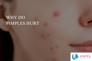 Why Do Pimples Hurt