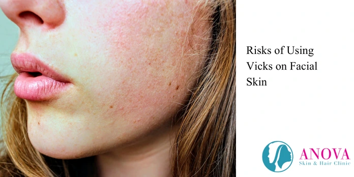 Risks of Using Vicks on Facial Skin