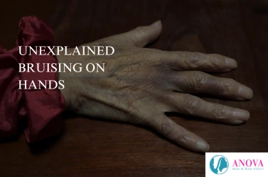 Unexplained Bruising on Hands: 7 Hidden Causes You Shouldn’t Ignore