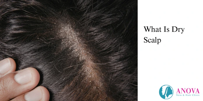 What Is Dry Scalp?