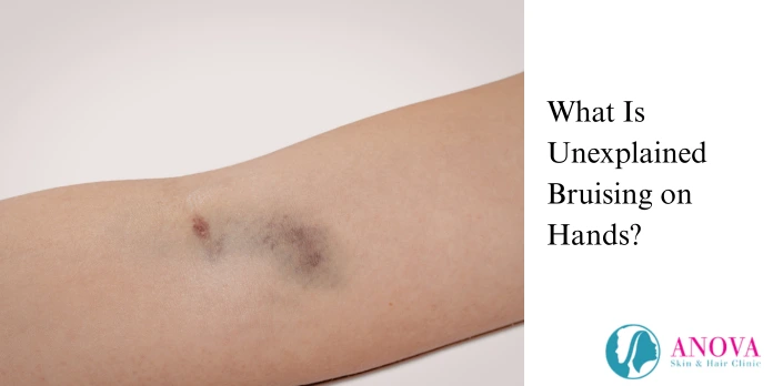 What Is Unexplained Bruising on Hands?