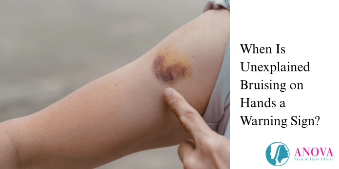 When Is Unexplained Bruising on Hands a Warning Sign?